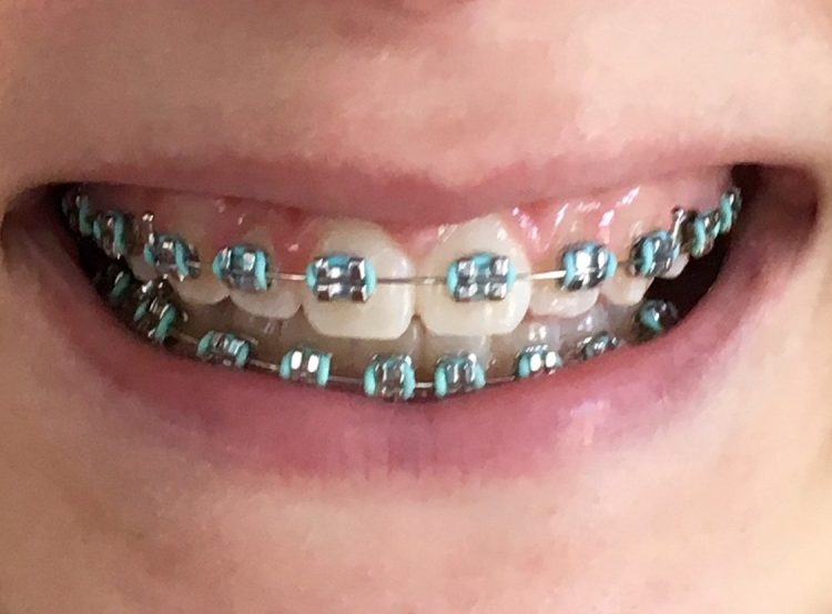 braces with blue bands by Dr. Tom Ferlito